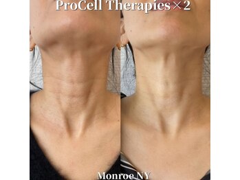 叶(Kanau)/プロセルセラピーズ首