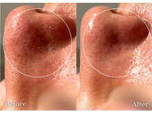 セレア(CELEA)/毛穴洗浄/毛穴レス／メンズOK