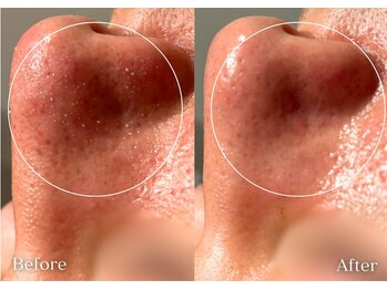 セレア(CELEA)/毛穴洗浄/毛穴レス／メンズOK