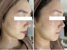 ホワイトアクア 岐阜店(WHITE AQUA)/ハーブピーリング/岐阜/ニキビ