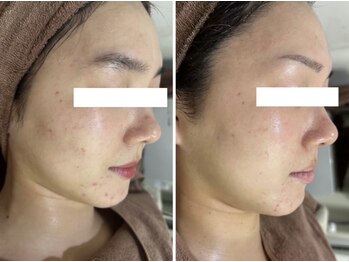 ホワイトアクア 岐阜店(WHITE AQUA)/ハーブピーリング/岐阜/ニキビ