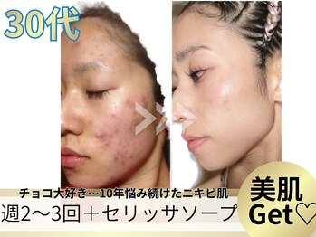 ヨサパーク ア モード ミオ 柴又店(YOSA PARK A modo mio)/肌荒れはもうさよなら!