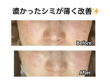 グレースティー 森町 箕面/シミが薄く改善！！★