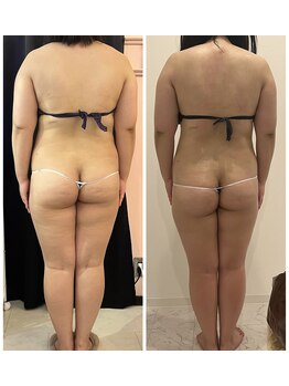 ビューティー アディクト(Beauty addict)/セルライトゼロで脂肪を撃退♪