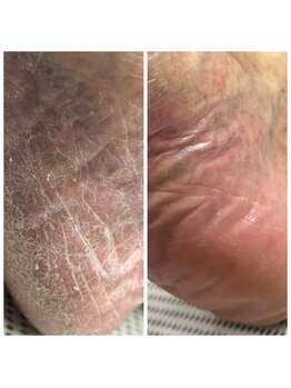 ドクターネイル爪革命 十条店/角質ケア