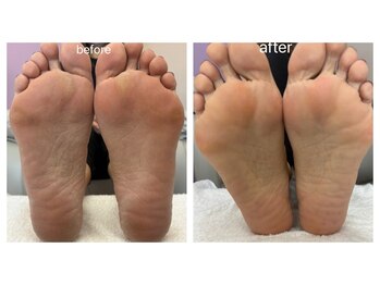 ネイルサロン ティプレシャス(T Precious)/つるつる♪足裏角質ケア♪