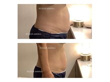 アクア エステティコ 亀有(ACQUA estetico)の雰囲気（キャビテーションやラジオ波で脂肪燃焼！60分コース　）