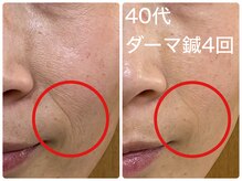 皇漢堂鍼灸療院/最新美容鍼【ダーマ鍼】での変化
