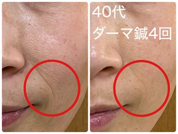 皇漢堂鍼灸療院/最新美容鍼【ダーマ鍼】での変化