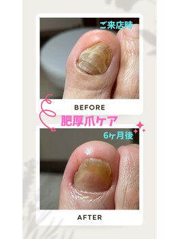 ドクターネイル爪革命 恵庭店/厚い爪・肥厚爪