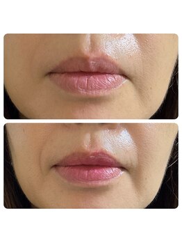 エクシア(ECXIA)/Pink Tone &nbsp;Program