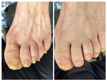 フレッシュフット(FreshFoot)/足のトラブルお任せください