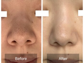 パルファンカルム 駅西本町店/毛穴の黒ずみにも!