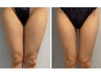 エイシスグロウ(asis glow.)/効果写真