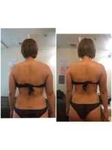 クレビオ/ハイパーリンパ　施術前→施術後