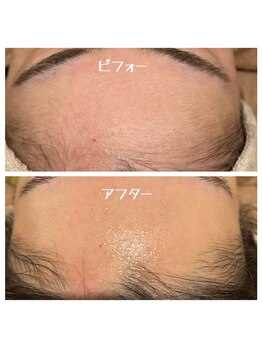 アネラセカンド 本町(ANERA Second)/フェイスwax脱毛