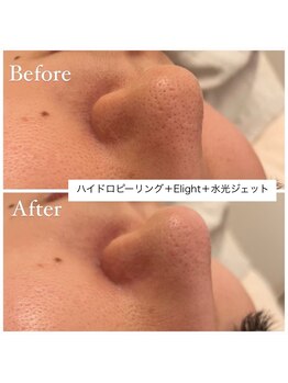 メゾンリュバン 梅田店(Maison Ruban)/毛穴洗浄・美白フォト|毛穴ケア