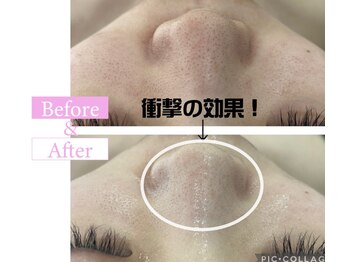 カンナムビューティー 町田/ハーブピーリング圧倒的毛穴レス