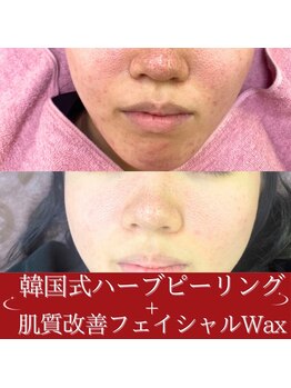 シロ(siro)/ダウンタイムあり！ピーリング