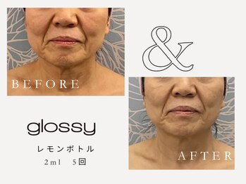 グロッシー(glossy)/【症例】レモンボトル口周り60代