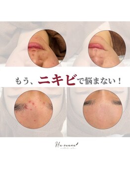 フルアナ(Hu ruana)/フェイシャルエステ