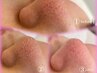 夏の毛穴大掃除キャンペーン【黒ずみ・角栓ケア】 
