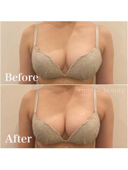 モット 神戸店(Motto)/光豊胸