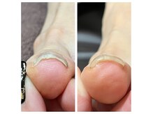 特殊ジェルを塗るだけの巻き爪ケア♪