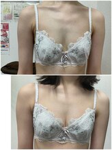 バーディー(BIRDIE)/施術３回/２０代/A→C