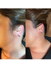 ゴールデンエイジ 吉祥寺(GOLDEN AGE)/ワックス脱毛 : 施術