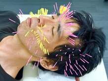 とだ鍼灸院/《美容鍼》男性の美容鍼も大歓迎