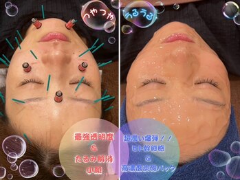 いきいき鍼灸整骨院 茨木市駅前院の写真/【美容鍼灸&潤い爆弾パック】超高濃度!!人幹細胞炭酸パック★肌の整えと美白に特化♪乾燥・小ジワケアに◎