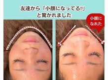 ピュアハリ/沖縄那覇美容鍼灸/小顔/たるみ