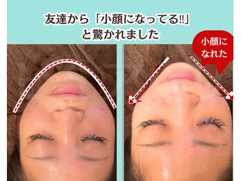 ピュアハリ/沖縄那覇美容鍼灸/小顔/たるみ