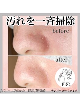 ナンバー511(No.511)/ 毛穴エステ/毛穴改善/毛穴ケア