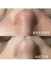 カウニス るる(kaunis)/【ララピール】Before After