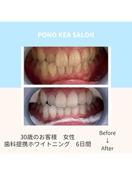 ポノケアサロン(PONO KEA SALON)/歯科提携ホワイトニング