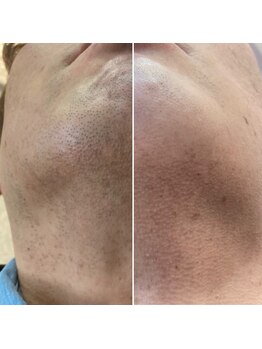 エピシアドットエヌ(epicia.N)/青ヒゲにさようなら