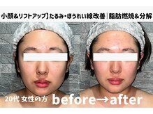 サロンスペース/20代 女性【小顔&リフトアップ】