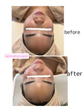 コア(Coeur)/【艶肌爆誕】lamination peeling