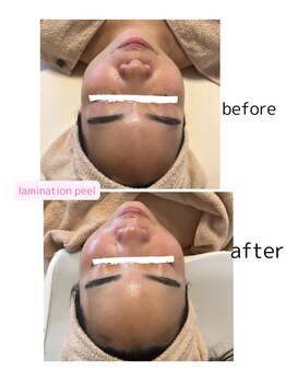 コア(Coeur)/【艶肌爆誕】lamination peeling