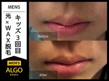 アルゴ 小松店(ALGO)/小学生口周り脱毛