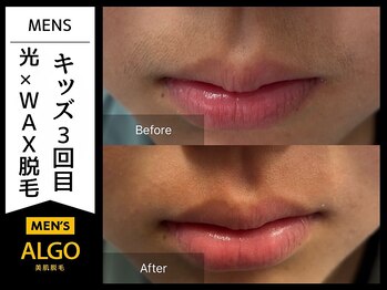 アルゴ 小松店(ALGO)/小学生口周り脱毛