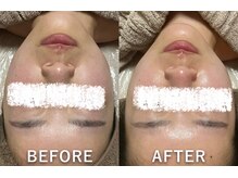 リュミエール(Lumiere)/小顔フェイシャル