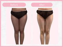 RHB 横浜店/【痩身コース】ビフォーアフター