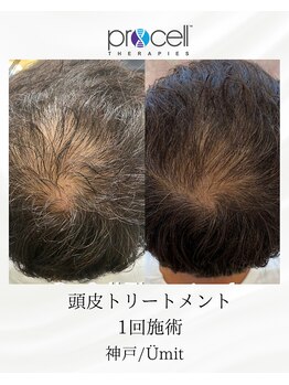 ユミト(Umit)/プロセルスカルプ