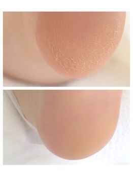 リペディア 熊谷(RePedia)/踵の悩み