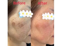 ソレイユ/光フェイシャル