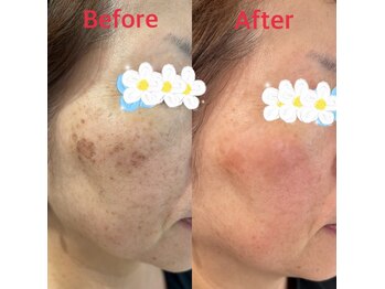 ソレイユ/光フェイシャル