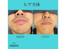 アクト クロ(ACT curro)/【ヒゲ全体】脱毛施術例